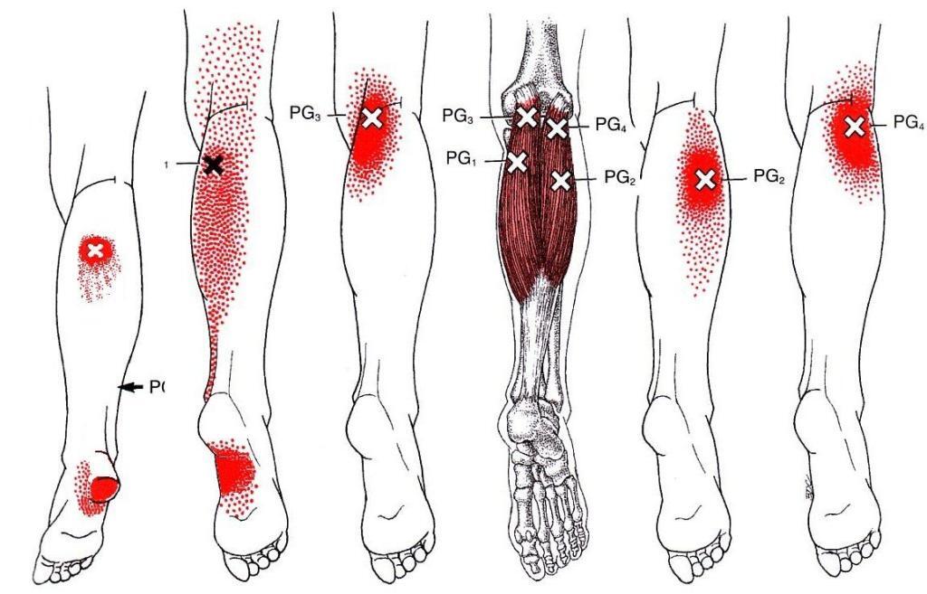 plantar fasciitis and trigger points